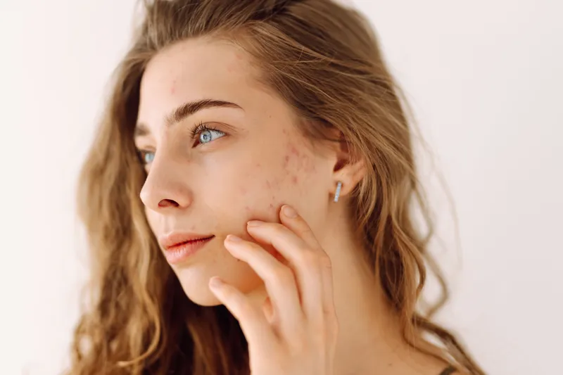 Best Acne Scar Treatments in Newport Beach: Laser, Laser, Lasers
